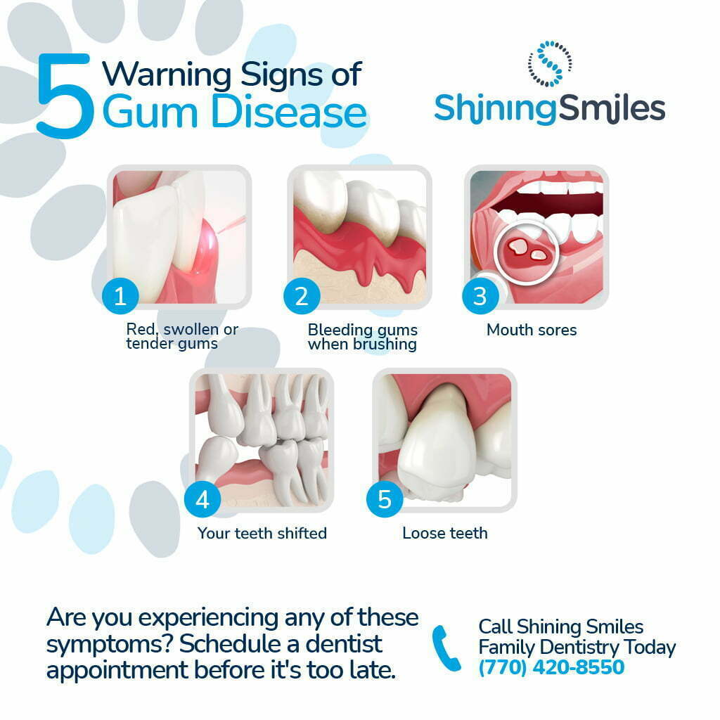 Warning Signs of Gum Disease IG